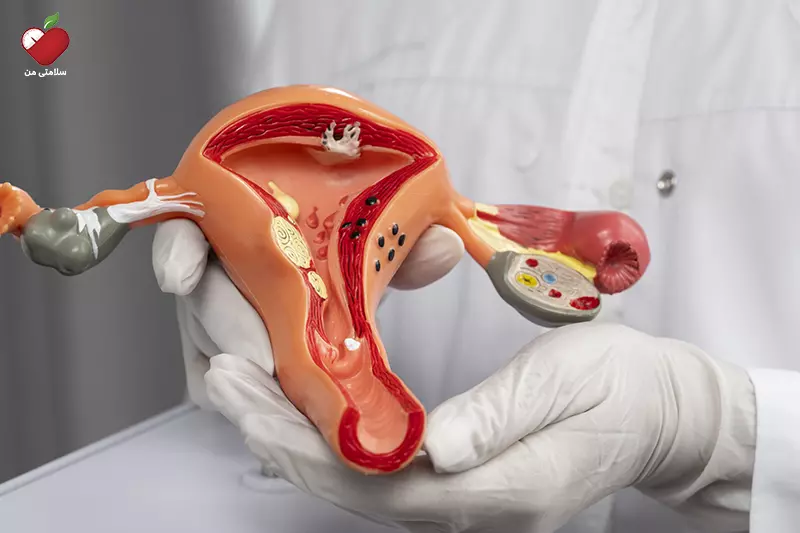 سندرم تخمدان پلی کیستیک (PCOS) در علائم دیابت در زنان