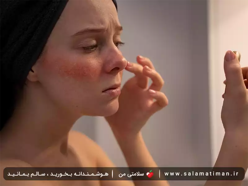 علایم کبد چرب در زنان روی پوست