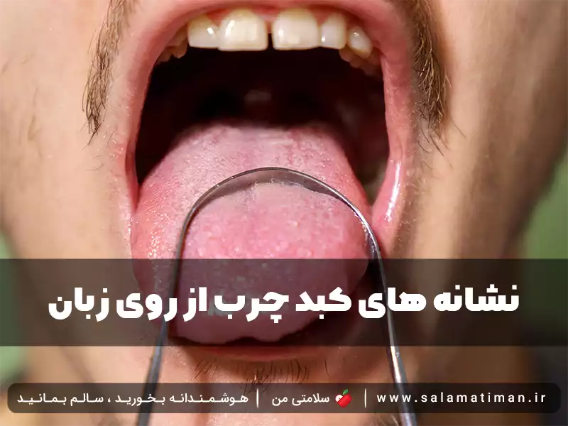 نشانه های کبد چرب از روی زبان